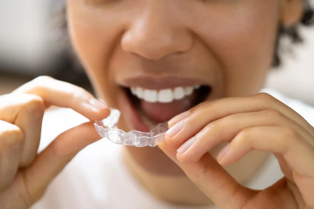 Common Mistakes with Invisalign in Charlotte