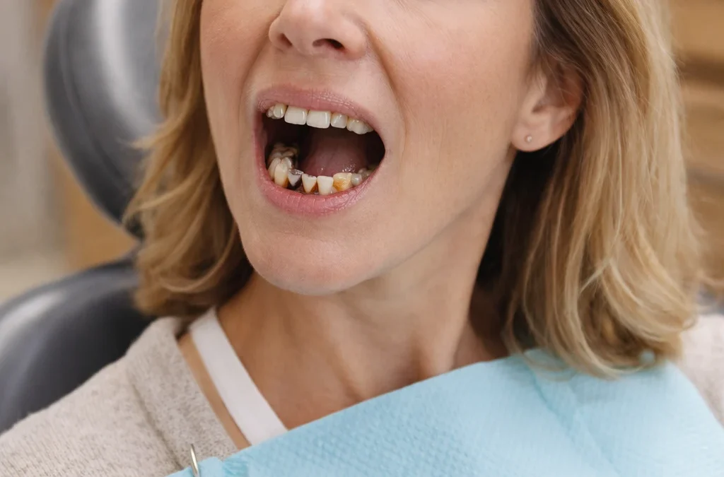 Why Dental Crowns Are the Best Solution for Damaged Teeth 