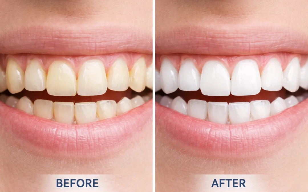5 Common Teeth Whitening Myths You Need to Stop Believing | Ed Hull, DDS Family & Cosmetic Dentistry 