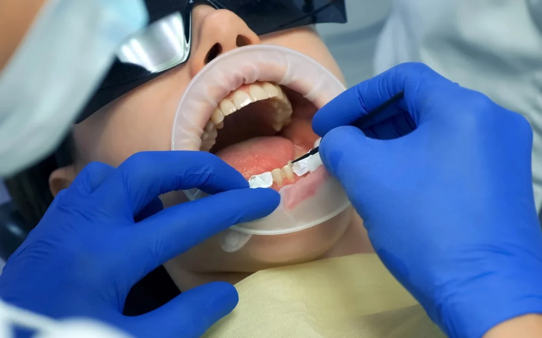 What to Expect During a Porcelain Veneer Consultation 