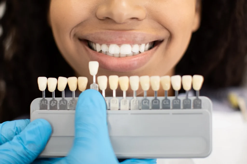 color matching of porcelain veneers charlotte