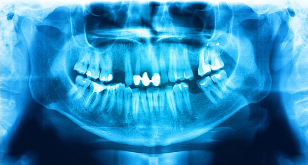 dental X-ray before a full mouth reconstruction charlotte nc