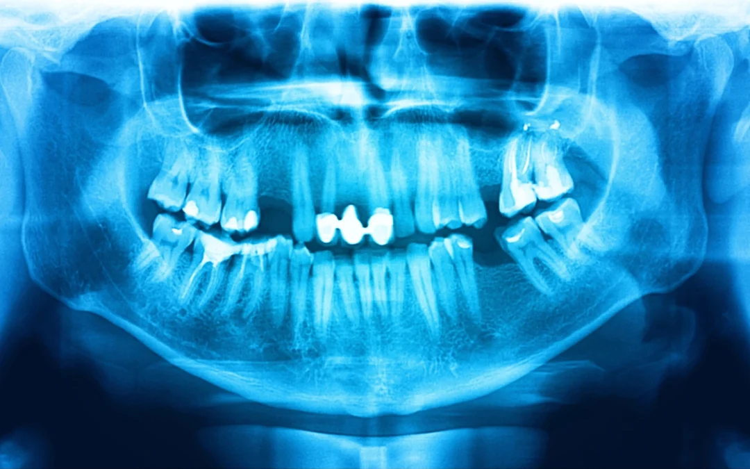 Common Dental Problems That May Require Full Mouth Reconstruction 
