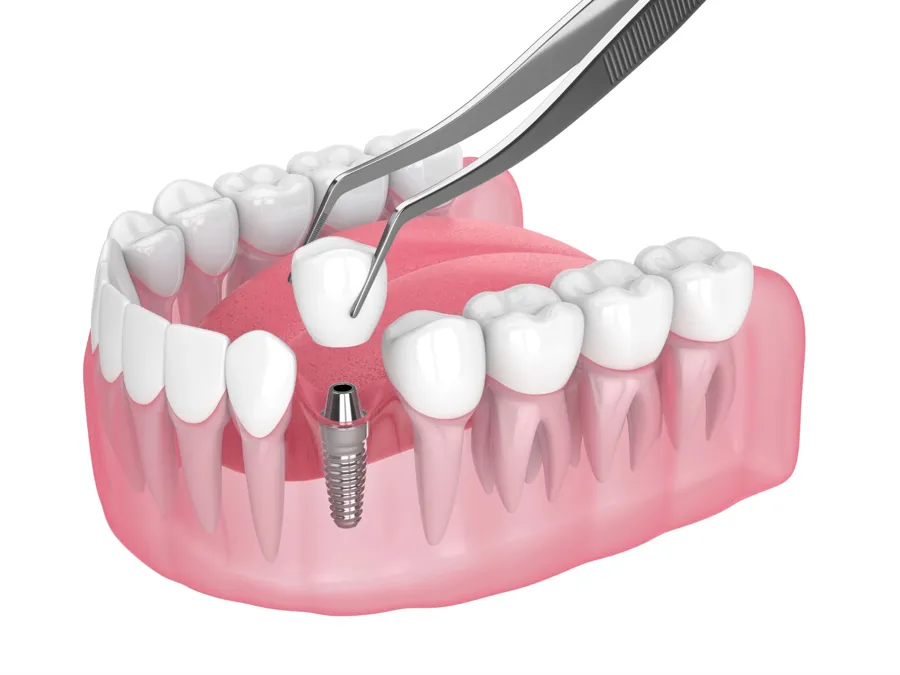 dentist_in_cotswold_dental_implant_surgery