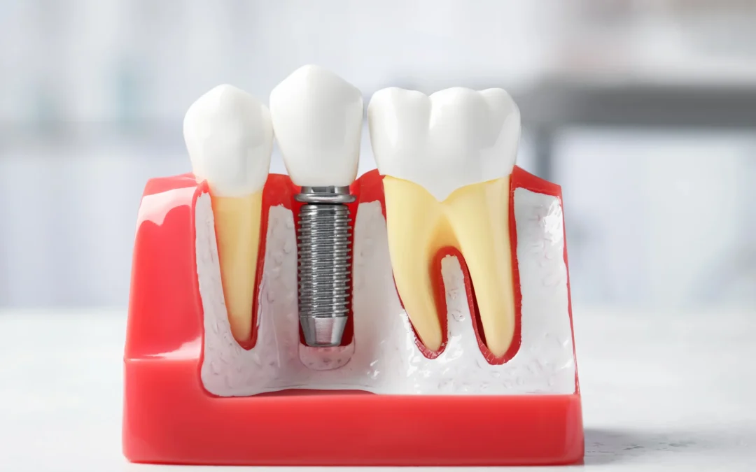 dental implants charlotte dental implant procedure