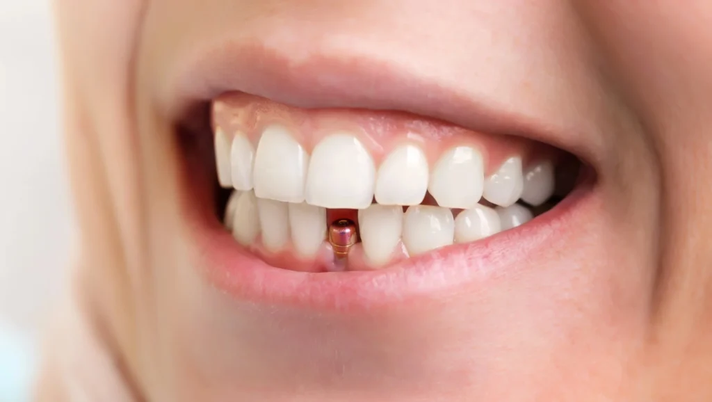 dental implants charlotte implant smile restoration
