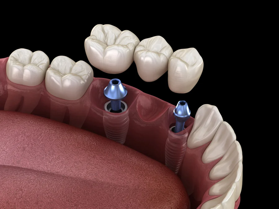 dental crowns charlotte 3d illustration of implant supported bridge