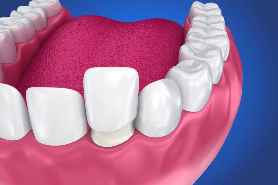 veneers charlotte 3d illustration of porcelain veneer placed on tooth