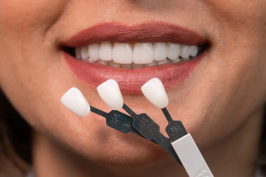 veneers charlotte smile with three porcelain veneer shade samples